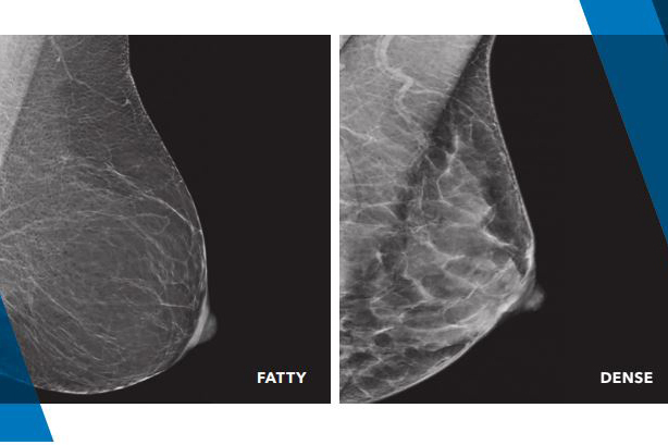 What should you know about breast density?